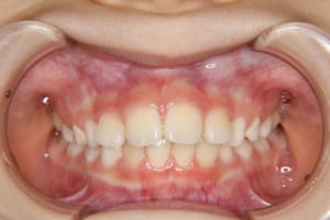 上顎前歯の前突、歯が斜めになっている、と来院